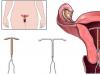 Typer av intrauterina enheter