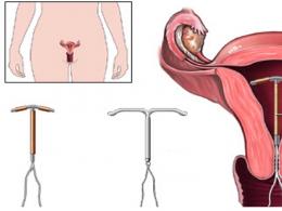 Tipi di dispositivi intrauterini